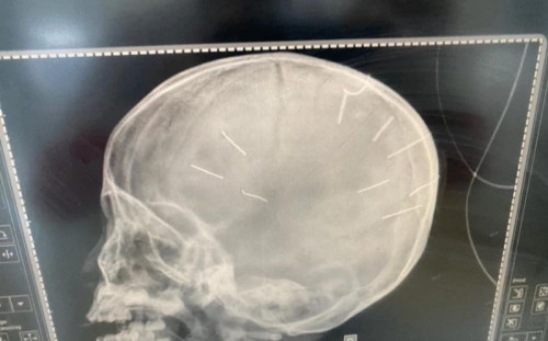 Cháu bé 3 tuổi ở Thạch Thất nguy kịch vì có nhiều đinh trong sọ não